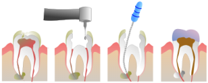 Root canal treatment in Bristol - Endodontics Treatment - Queen Square Dental Clinic